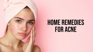 7 home remedies to get rid of acne