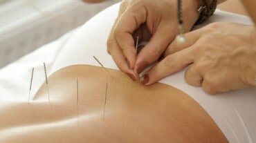 Acupuncture therapy