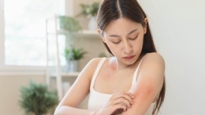 Caterpillar rash can cause skin irritation, know what to do about it