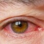 Conjunctivitis