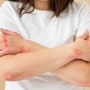 A woman with red spots on her skin