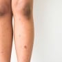 Dark spots on legs